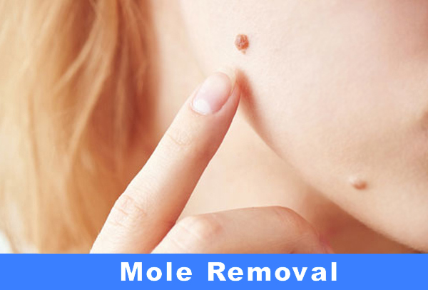 Mole, Tags and Warts Removal